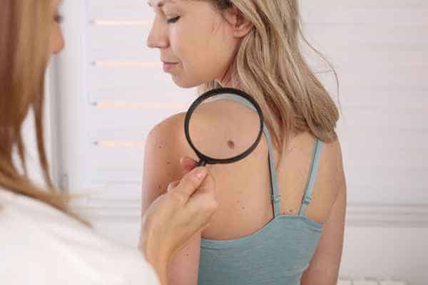 What Are Traditional Skin Lesion Removal Methods Chinnor?