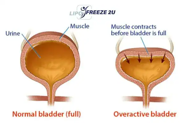 diagram of overactive bladder treatment Chinnor