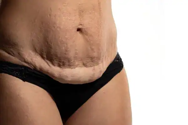 loose skin after weight loss injections Chinnor