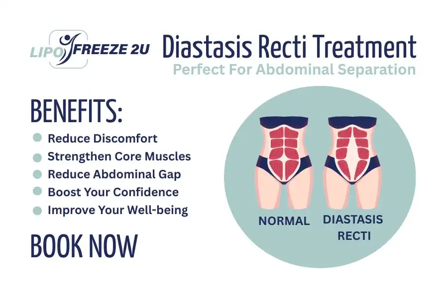 Benefits of body toning treatment Chinnor for Diastasis recti