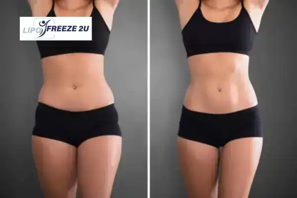 How Can LIPO FREEZE 2U Support Your Post-Pregnancy Body Recovery Chinnor?