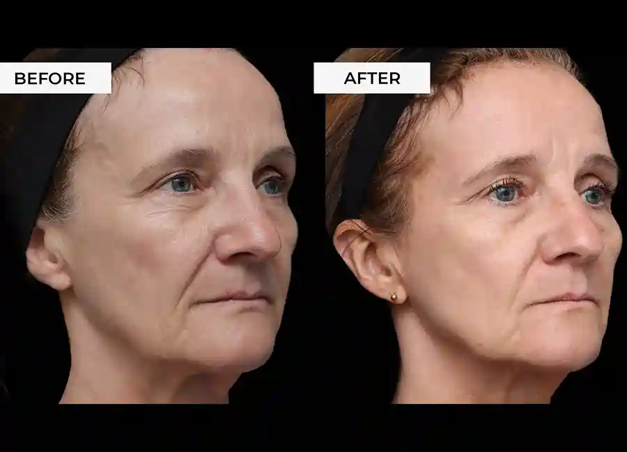 How Many RF Microneedling Sessions Will You Need to See a Difference Chinnor?