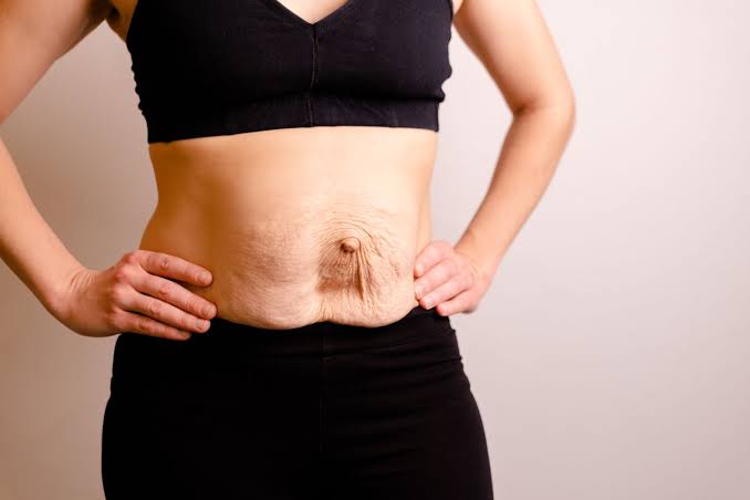 Is Surgery Really the Only Way to Repair Diastasis Recti Chinnor?