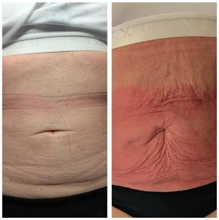 How Does RF Microneedling Improve Crepey, Thin and Uneven Skin Texture Chinnor?