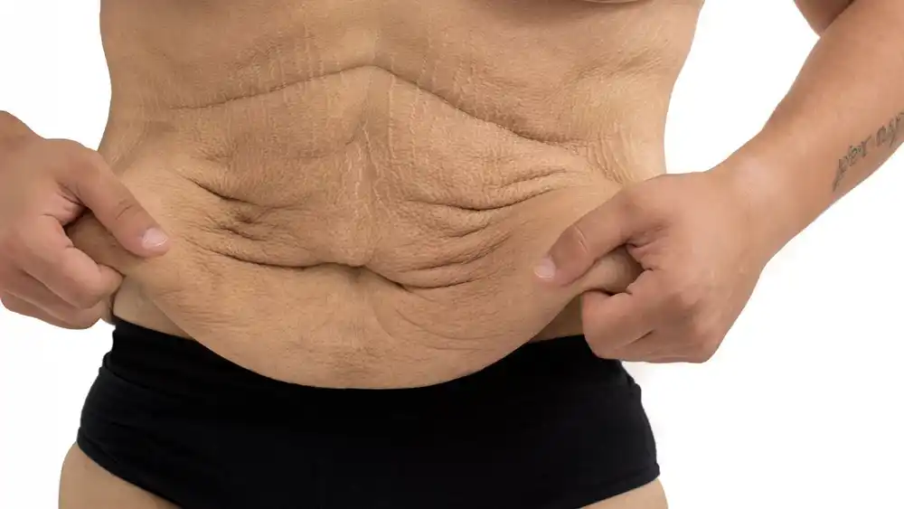 Why Does Weight Loss Medication Leave Some People With Loose or Sagging Skin Chinnor?